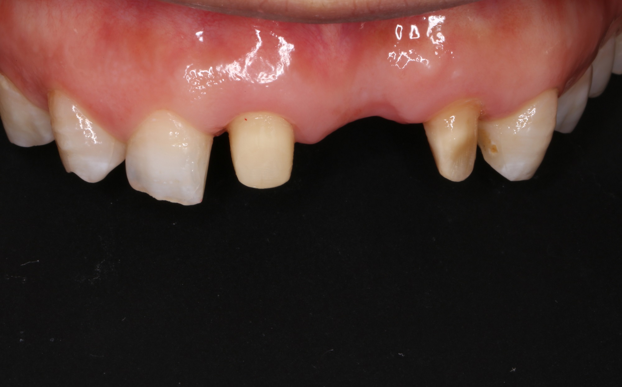 无牙颌种植上部修复-瑞佳义齿