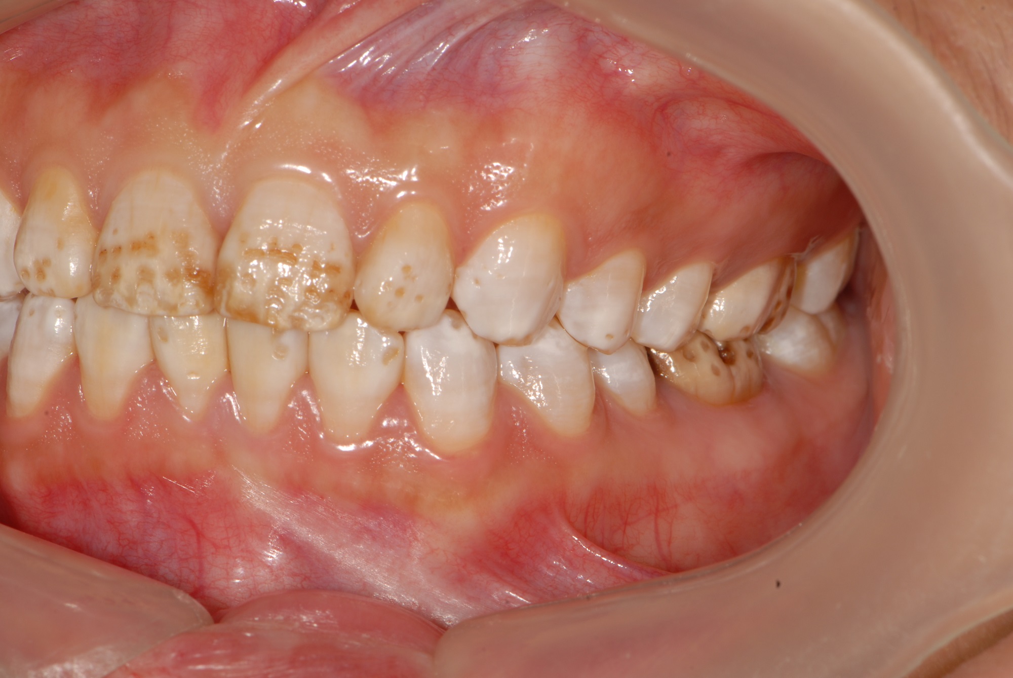 牙齿出现黑点？警惕！|黑点|牙齿|警惕|口腔|牙线|食物|-健康界