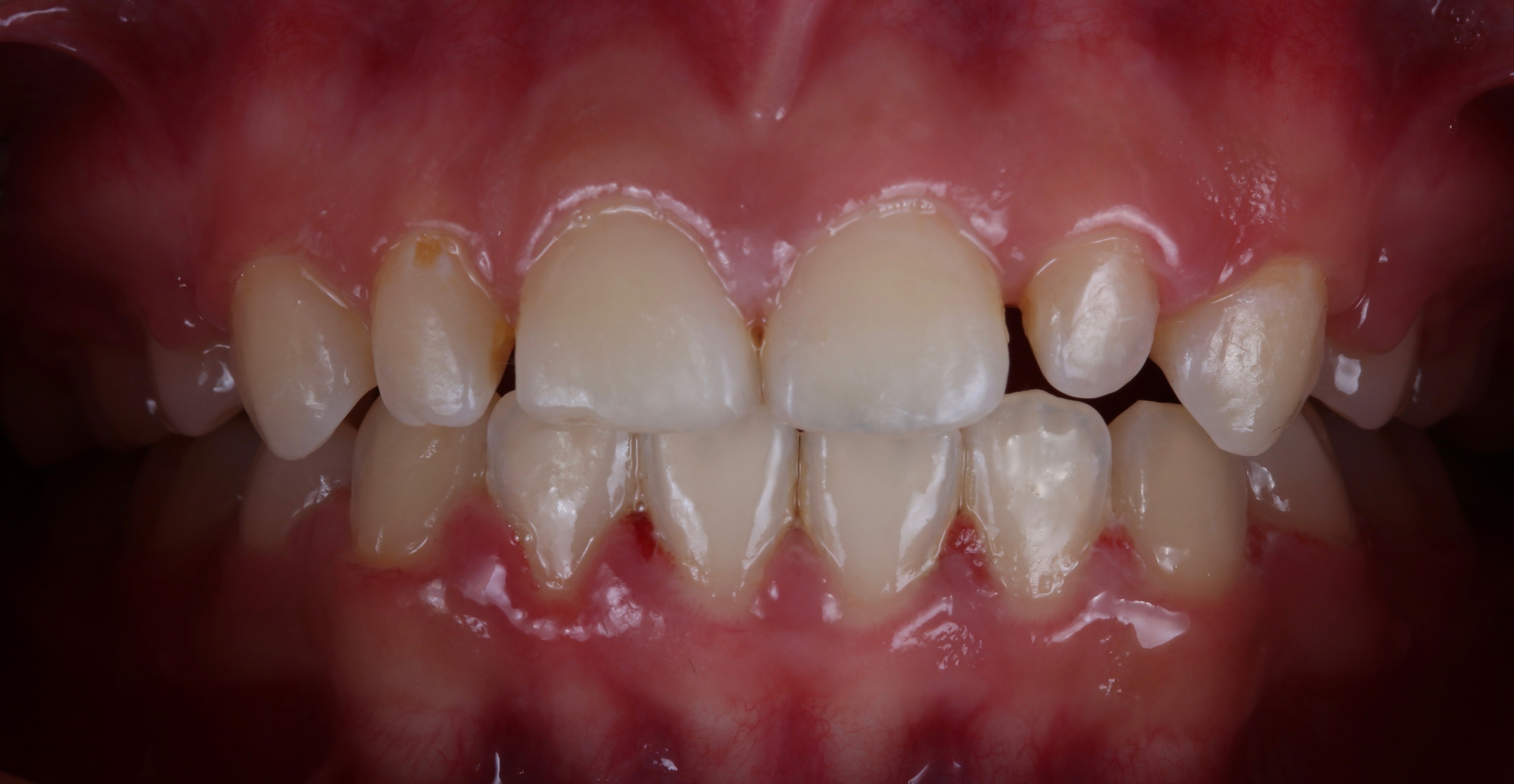 虫牙图片严重蛀牙,虫牙蛀牙黑牙图片,虫牙的图片蛀牙_大山谷图库